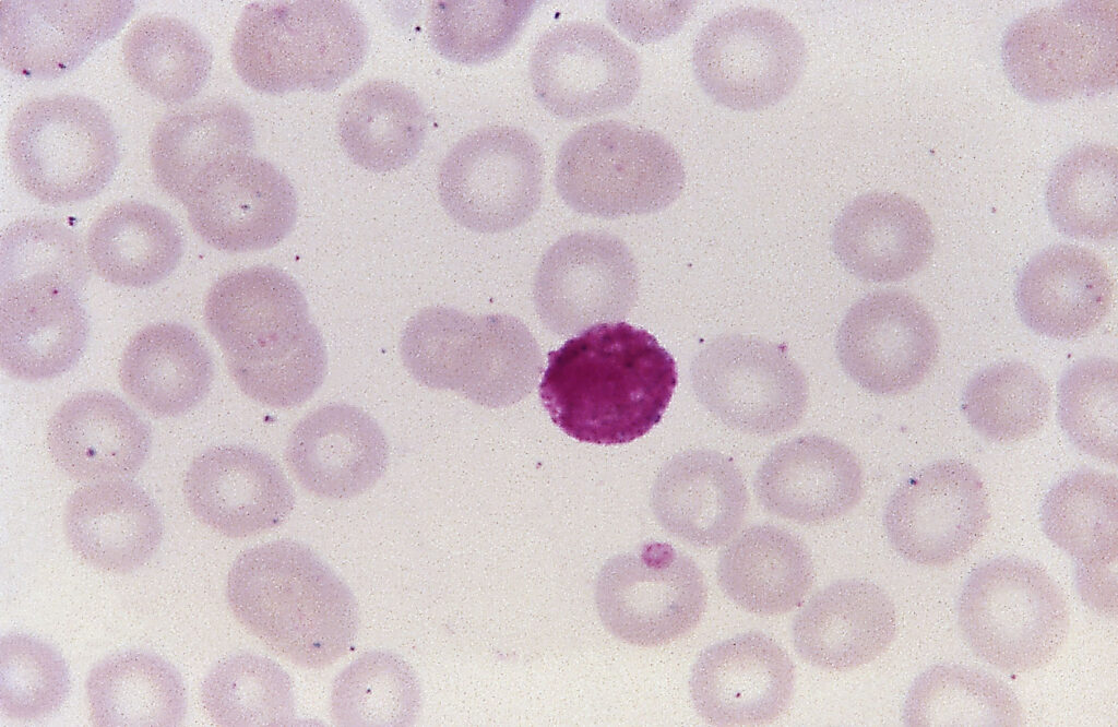Malaria
